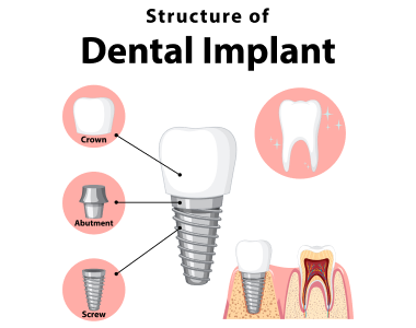dental implants SOUTH BEND IN